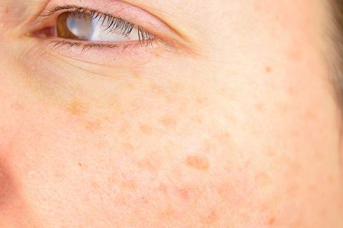 Stubborn age spots or acne?